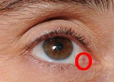 علائم سرطان چشم چیست و روش درمان آن چه می باشد؟ علائم سرطان چشم چیست و روش درمان آن چه می باشد؟